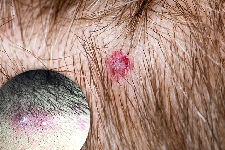 頭瘡成因-症狀-治療-脫髮-皮膚科專科胡惠福醫生