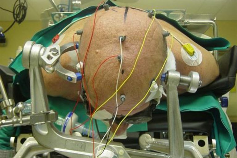 腦神經手術-微創脊椎手術-電生理監察提升手術成功率-神經外科專科醫生-麥偉傑