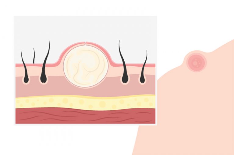 粉瘤-特徵-成因-激光治療-全科袁靜怡醫生