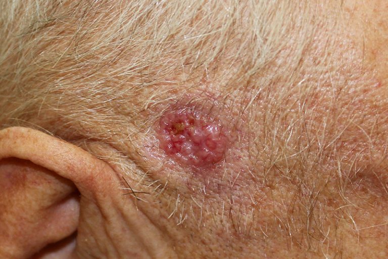 皮膚癌特徵-良性皮膚斑點-身體痣-戴燕萍-臨床腫瘤科專科醫生