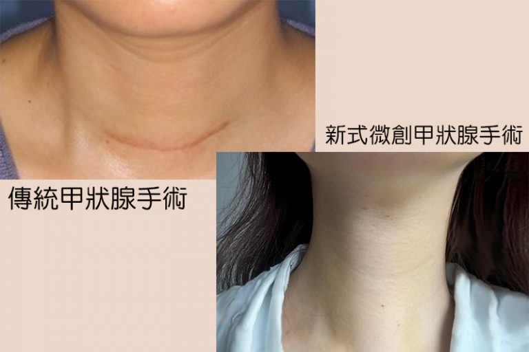 甲狀腺結節治療-無疤微創手術-耳鼻喉科專科醫生李學楠