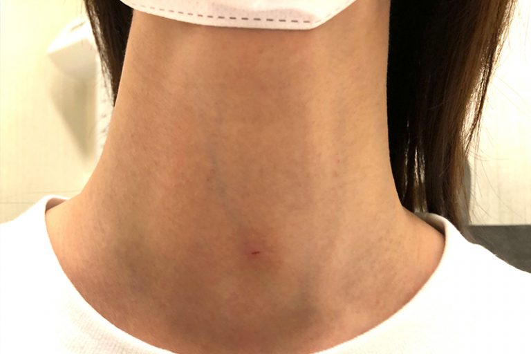 甲狀腺結節治療-無疤微創手術-耳鼻喉科專科醫生李學楠