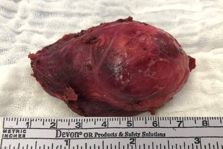 甲狀腺結節治療-無疤微創手術-耳鼻喉科專科醫生李學楠